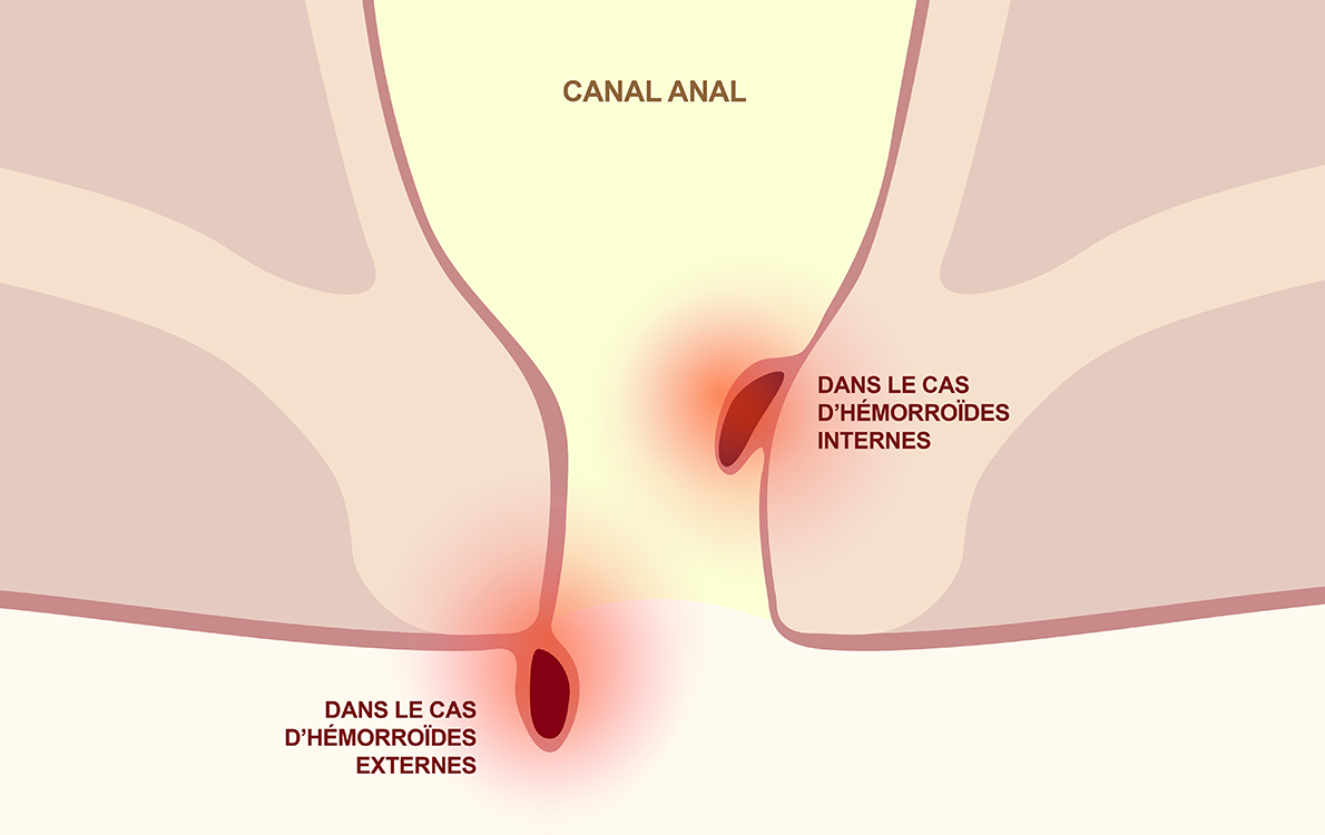Les hémorroïdes, qu'est-ce que c'est ?
