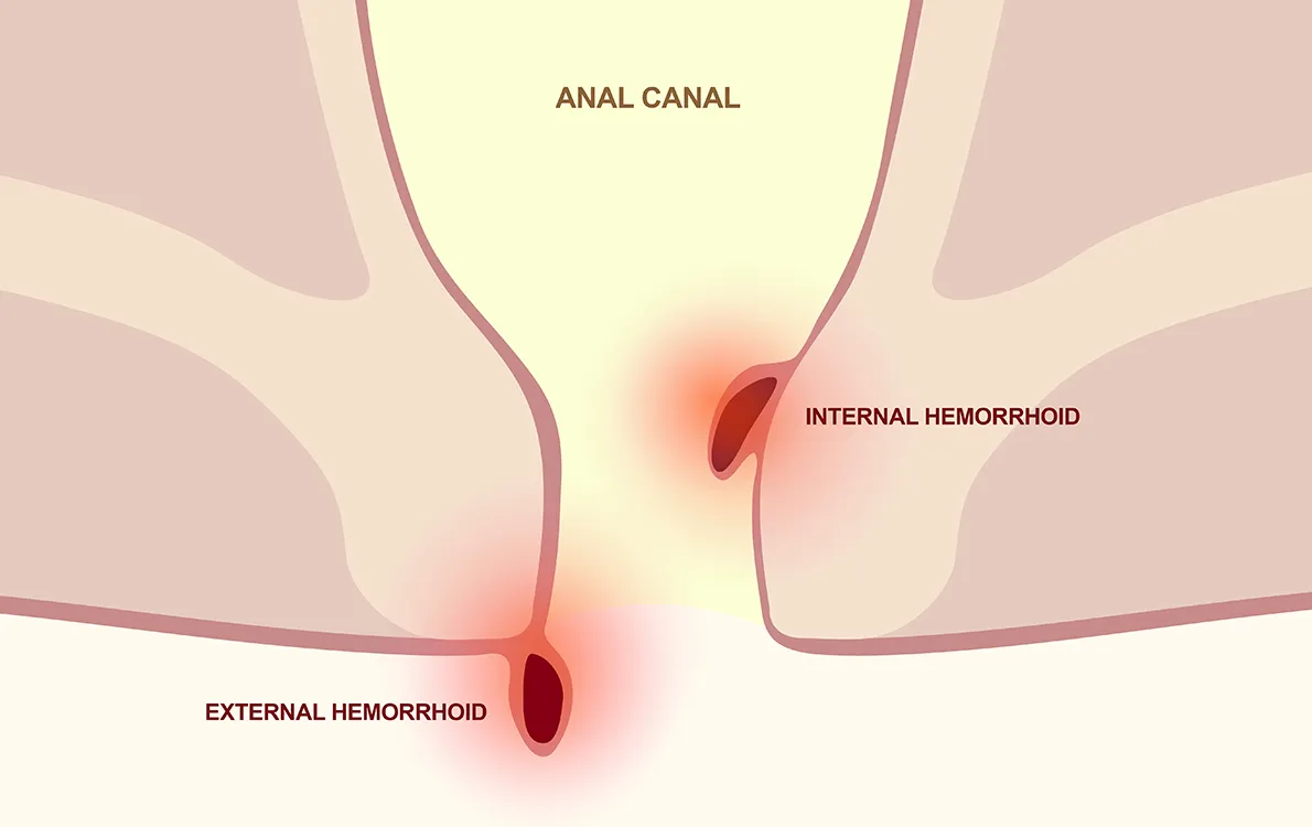 What are hemorrhoids?