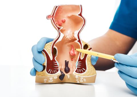 What causes hemorrhoids?
